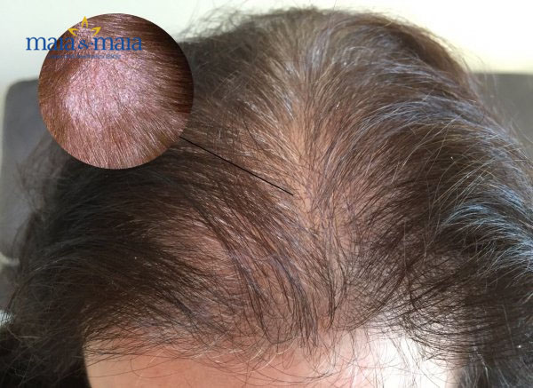 Vảy nến da đầu chịu sự chi phối của yếu tố di truyền Vảy nến da đầu chịu sự chi phối của yếu tố di truyền