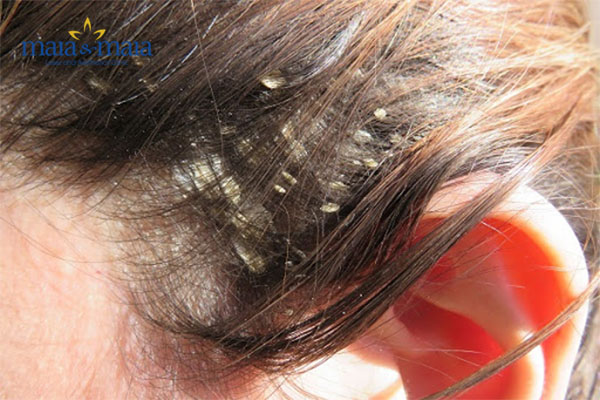 Nên đi khám bác sĩ chuyên khoa càng sớm càng tốt để ngăn ngừa bệnh vảy nến da đầu Nên đi khám bác sĩ chuyên khoa càng sớm càng tốt để ngăn ngừa bệnh vảy nến da đầu