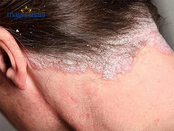 Triệu chứng của bệnh vảy nến da đầu Triệu chứng của bệnh vảy nến da đầu