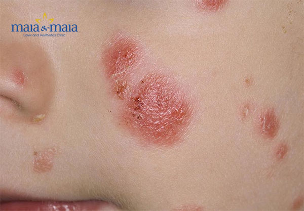 Bệnh vảy nến ở trẻ Bệnh vảy nến ở trẻ