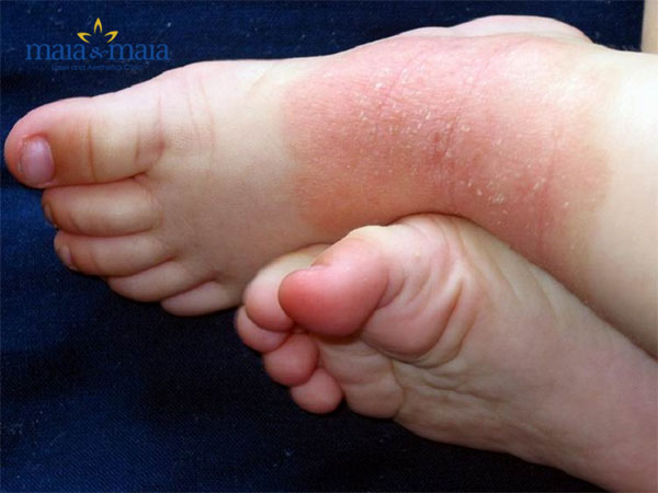 Triệu chứng của bệnh vảy nến Triệu chứng của bệnh vảy nến