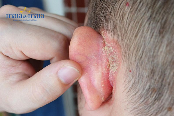 Hình ảnh bệnh vảy nến Hình ảnh bệnh vảy nến