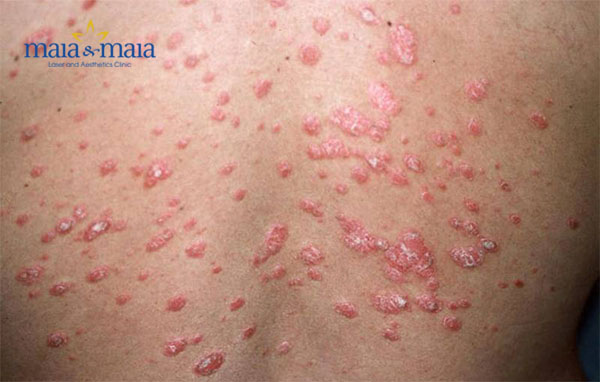 Vảy nến thể giọt Vảy nến thể giọt
