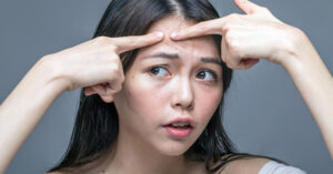 Tránh các thành phần ảnh hưởng tới da mụn