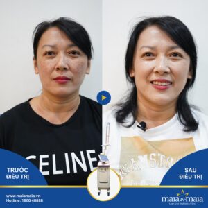 Nám da ở xuất hiện ở độ tuổi 25 trở đi