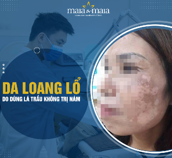 Da loang lổ do sử dụng lá trầu không trị nám Da loang lổ do sử dụng lá trầu không trị nám