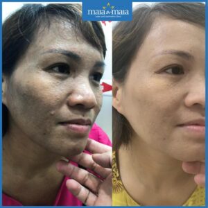 Điều trị nám da có gây tổn thương da không?