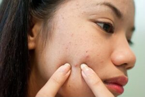 Da mụn cần được chăm sóc đặc biệt