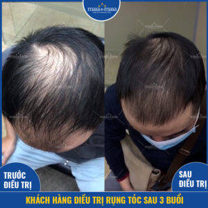 Kết quả hỗ trợ điều trị rụng tóc, hói đầu tại phòng khám Kết quả hỗ trợ điều trị rụng tóc, hói đầu tại phòng khám