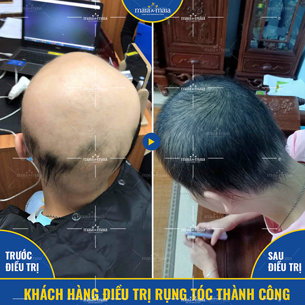 Kết quả hỗ trợ điều trị rụng tóc, hói đầu tại phòng khám Kết quả hỗ trợ điều trị rụng tóc, hói đầu tại phòng khám