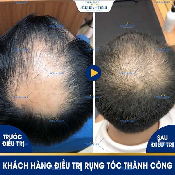 hói đầu