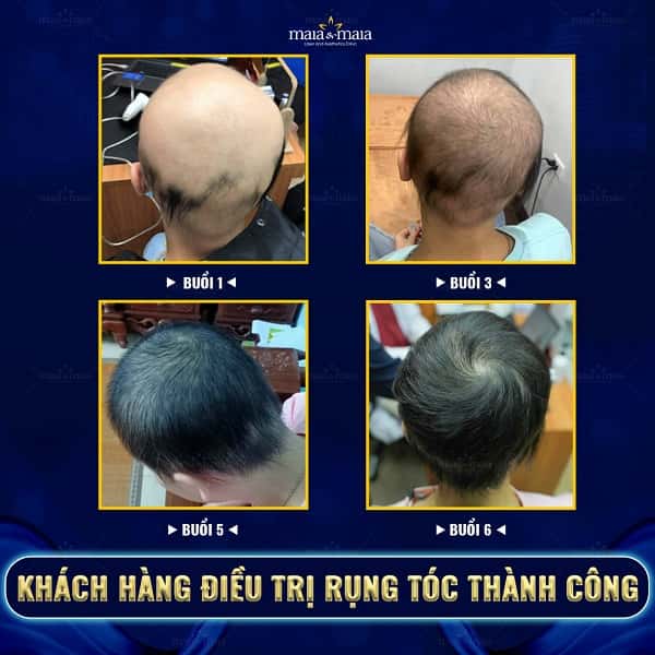 hói đầu