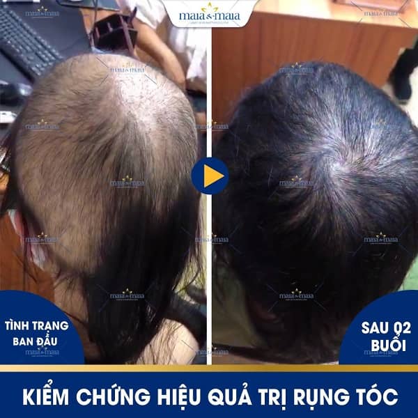 hói đầu