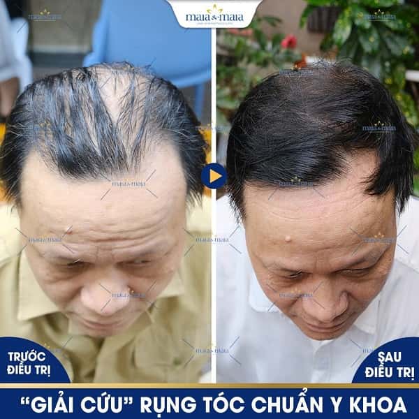 hói đầu
