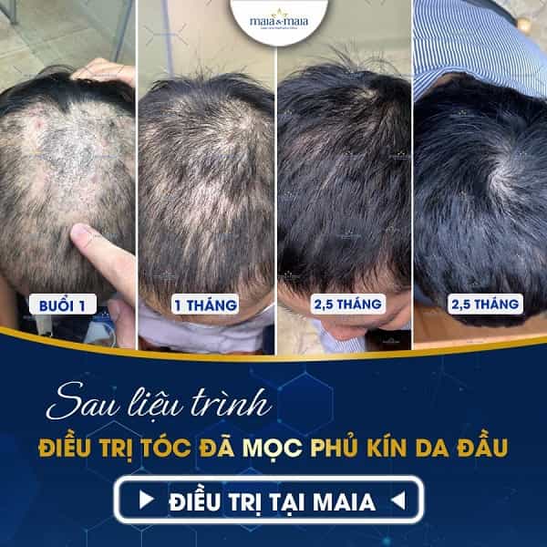 hói đầu