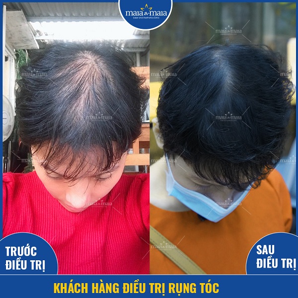 Hiệu quả sau khi điều trị rụng tóc thành công