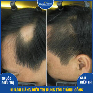Kết quả hỗ trợ điều trị rụng tóc, hói đầu tại phòng khám Kết quả hỗ trợ điều trị rụng tóc, hói đầu tại phòng khám