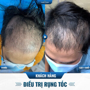 Kết quả hỗ trợ điều trị rụng tóc, hói đầu tại phòng khám Kết quả hỗ trợ điều trị rụng tóc, hói đầu tại phòng khám