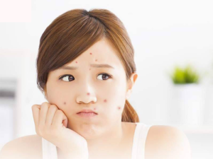 Do hoocmon thay đổi nên tuyến bã nhờn hoạt động mạnh hơn