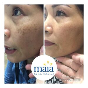 Hiệu quả điều trị nám tại Maia