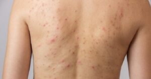 Mụn không nguy hiểm nhưng mang lại phiền toái vô cùng lớn