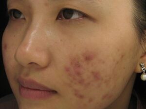 Không xử lý nhân mụn sớm và đúng cách