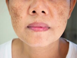 Xác định nguyên nhân để điều trị nám da đúng cách