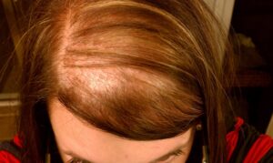 Một tình trạng hói đầu nặng ở nữ giới