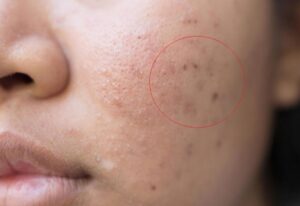 Cùng Maia&Maia tìm hiểu về thâm mụn