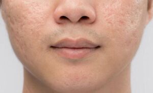 Có rất nhiều nguyên nhân, trong đó mụn trứng cá là chủ yếu khiến sẹo hình thành