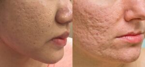 Có nhiều loại sẹo khác nhau do các nguyên nhân khác nhau mà tạo thành.