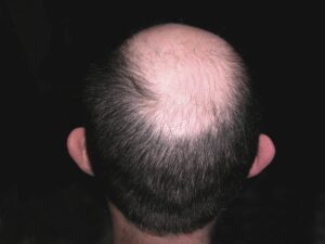 Rụng tóc hói trên đỉnh đầu