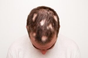 Rụng tóc từng mảng ở nam giới