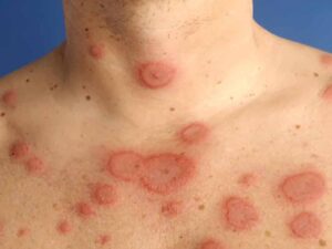 Lupus ban đỏ với biểu hiện thường thấy là phát ban cánh bướm