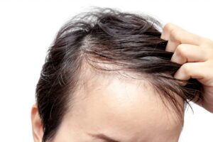 Rụng tóc thưa dần ở hai bên thái dương