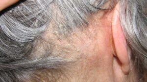 Thuốc uống có thể được kê đơn nếu tình trạng viêm da rụng tóc nặng
