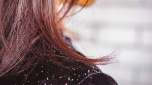 Rụng tóc kèm theo gàu