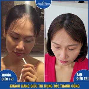 Khách hàng điều trị rụng tóc hói đầu thành công