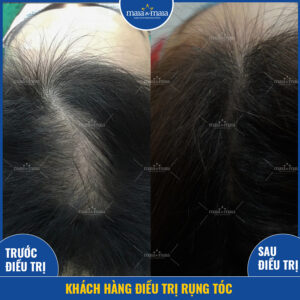 Khách hàng điều trị rụng tóc thành công Khách hàng điều trị rụng tóc thành công