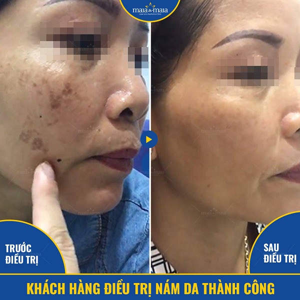 Cần cẩn trọng với các phương pháp trị nám chưa được kiểm chứng