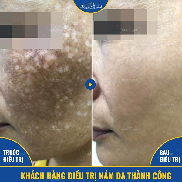 Cần sử dụng đúng phương pháp để loại bỏ nám
