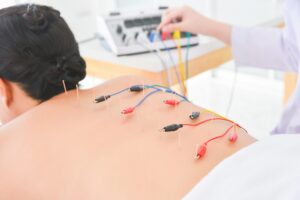 Điện châm kết hợp châm cứu và dòng điện nhỏ