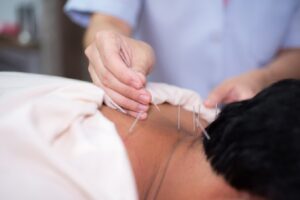 Chữa rụng tóc bằng châm cứu là dùng kim châm vào những huyệt vị có liên quan tới sự phát triển của tóc
