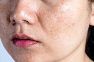 Nám da có thể xuất hiện một cách lặng lẽ