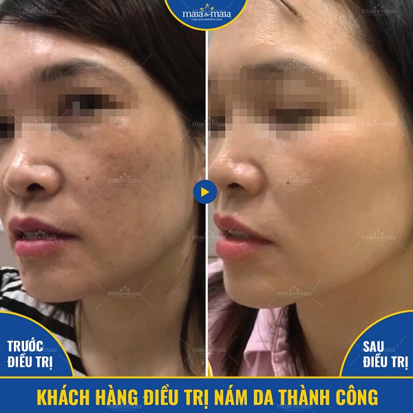 Tình trạng nám da có thể xuất phát từ việc dùng sản phẩm chăm sóc da sai cách