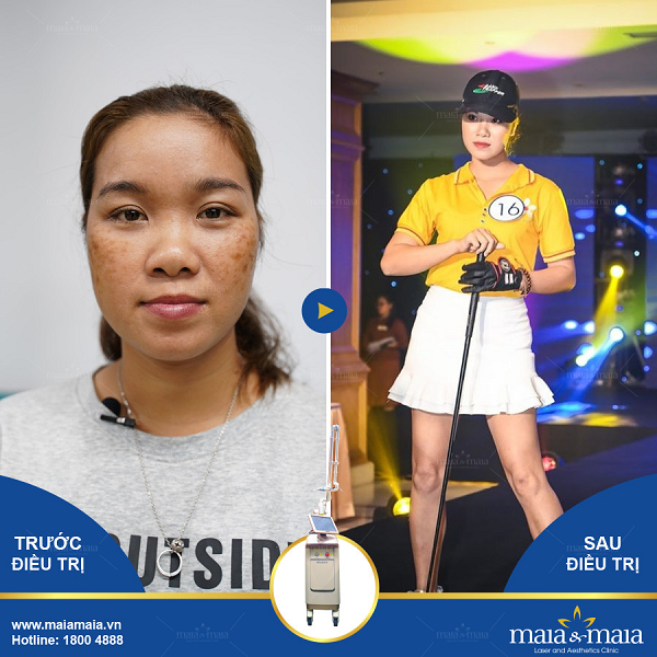 Điều trị nám bằng đa trị liệu tại phòng khám Maia