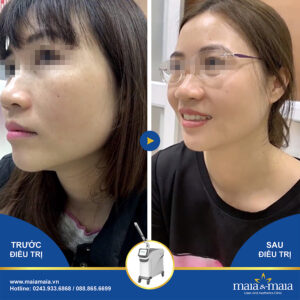 Kết quả điều trị nám da tại Maia
