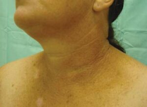 Nám da đôi khi xuất hiện tại cổ, vùng lưng hoặc những nơi thường xuyên tiếp xúc ánh mặt trời