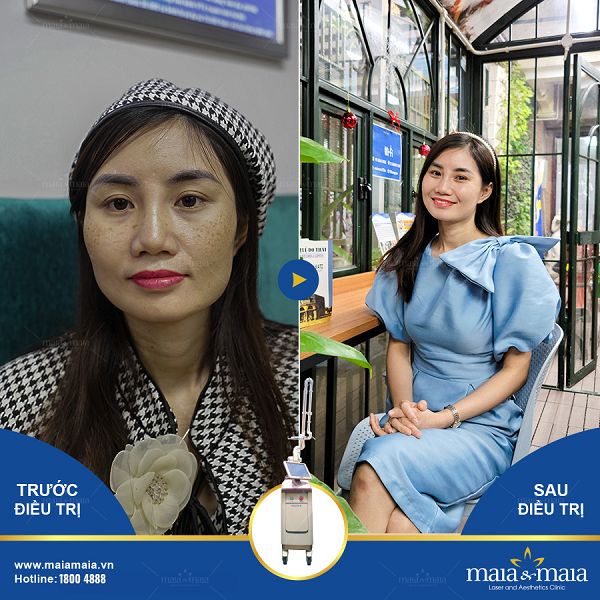Điều trị nám da bằng phương pháp đa trị liệu tại phòng khám Maia