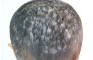 Vitamin D được cho là có liên quan tới chứng rụng tóc từng mảng